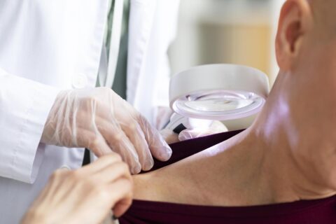 Epidermoid Cyst Removal